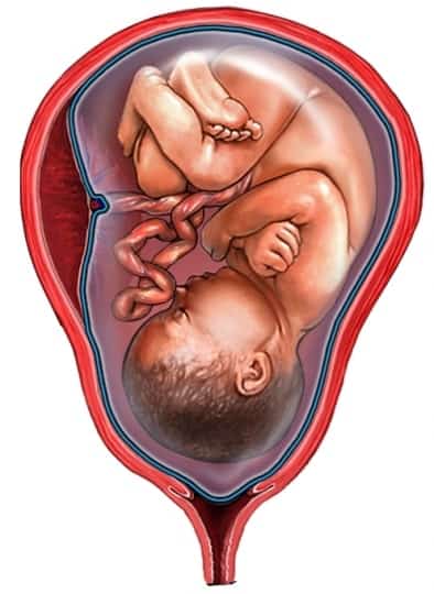 premature rupture of membranes